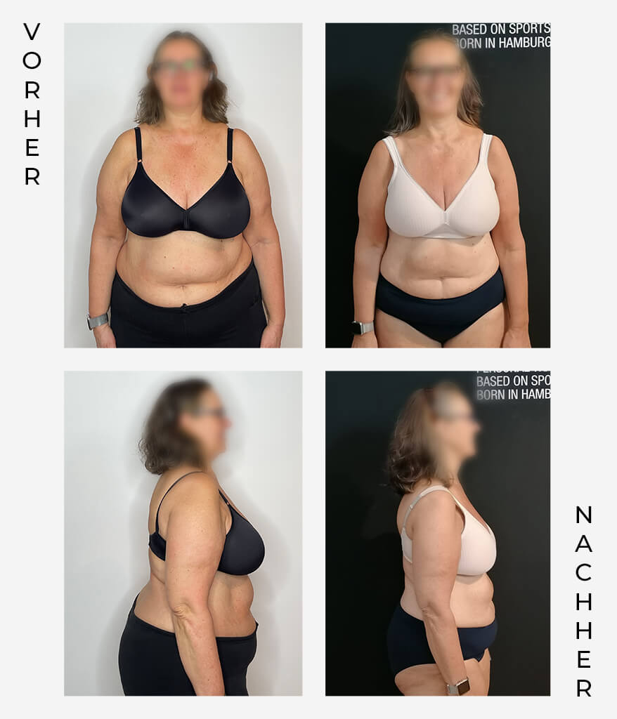 Vorher-Nachher-Fotos einer Frau, die vor einem Hintergrund steht, von vorne und von hinten gezeigt. Die linke Spalte ist mit "Vorher" und die rechte Spalte mit "Nachher" beschriftet.